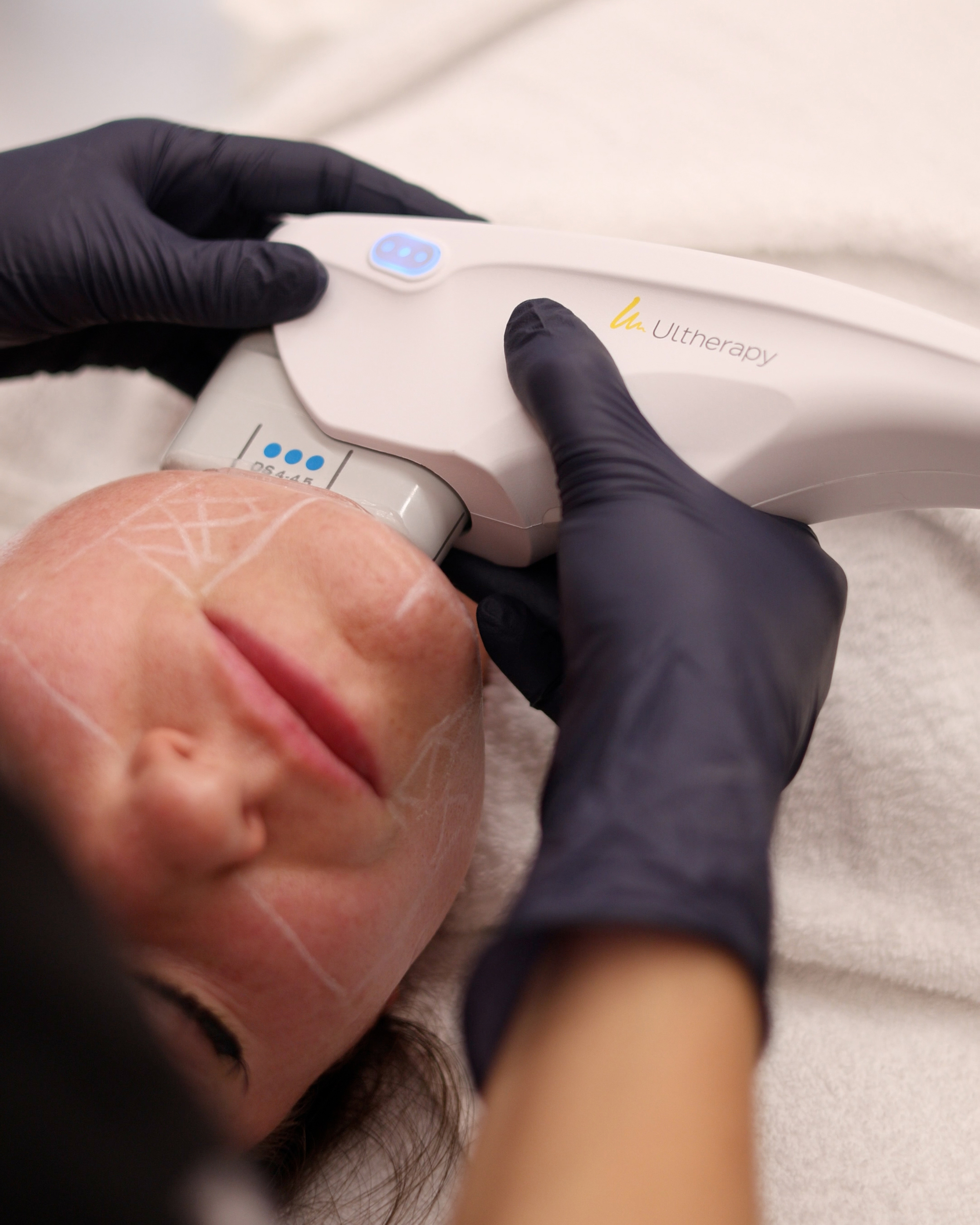 Ultherapy® Prime (Vancouver) product image